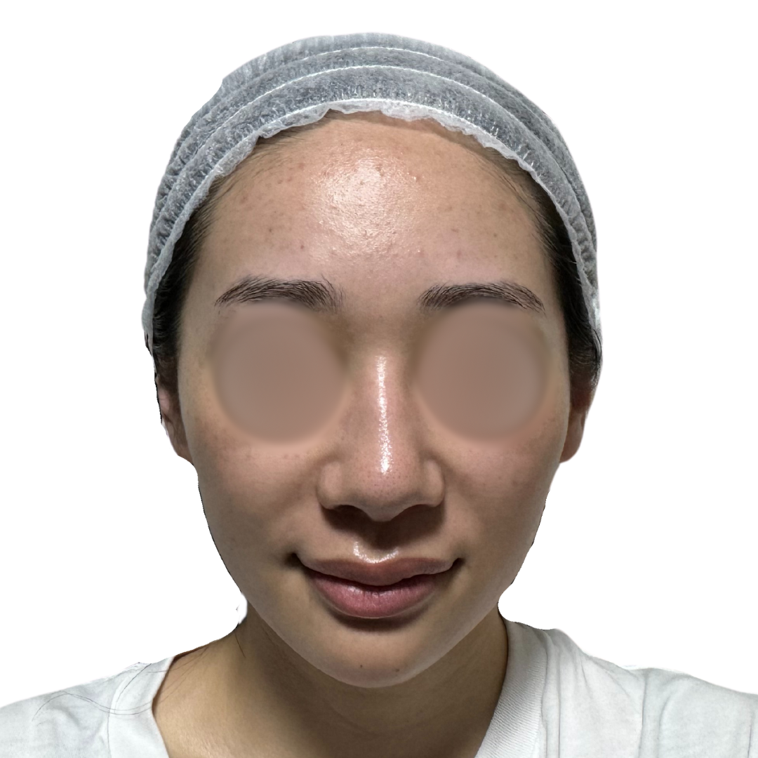 水光注射（スキンブースター）